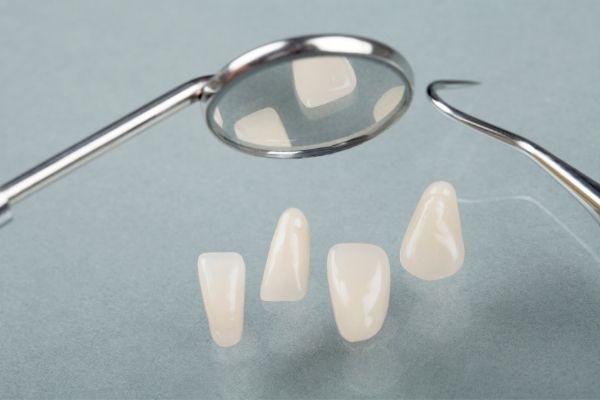 Dental veneers