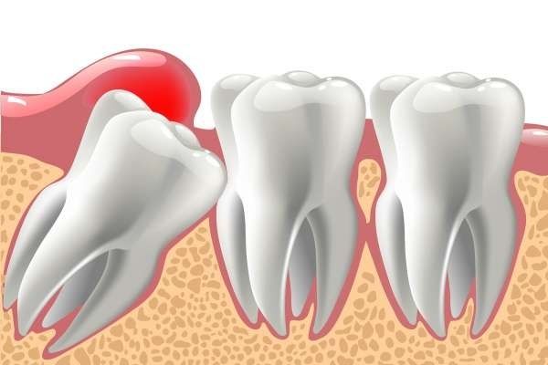 Wisdom teeth