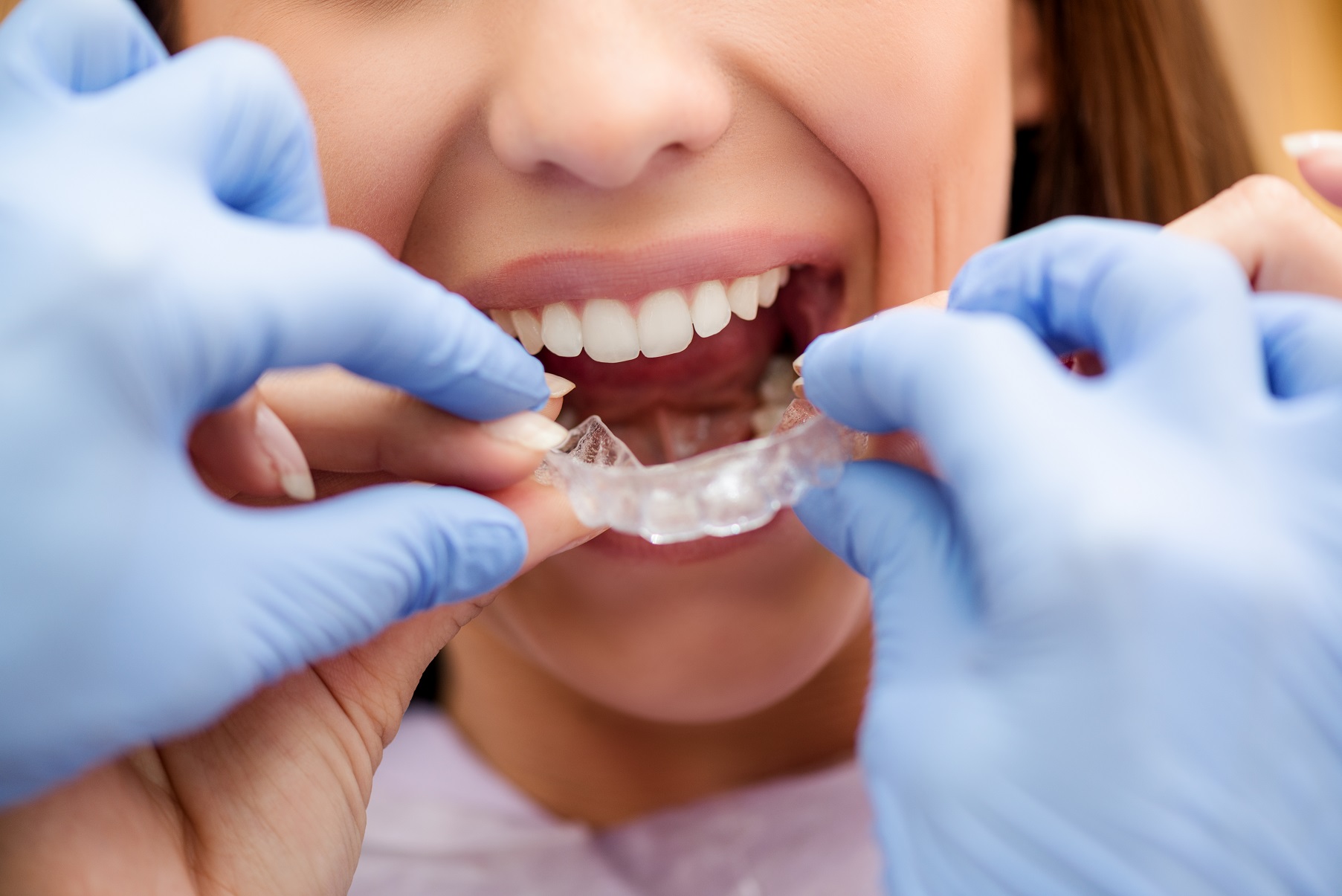 Orthodontie Invisalign slider | Centre dentaire Singer à St-Jean-sur-Richelieu